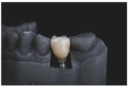 임플란트 장단점