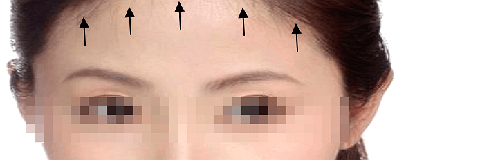 이마 울쎄라-시술-후-모습