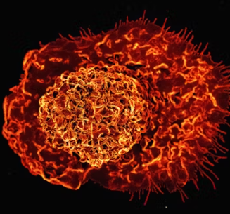 전립선 비대증 증상 치료 수술비용