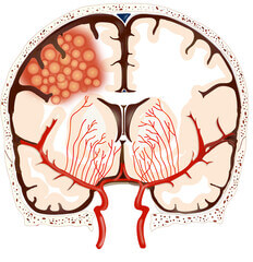 뇌종양 증상 치료방법