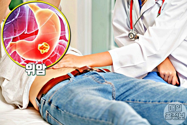 혈액형별 잘 걸리는 병 질환, a형 위암