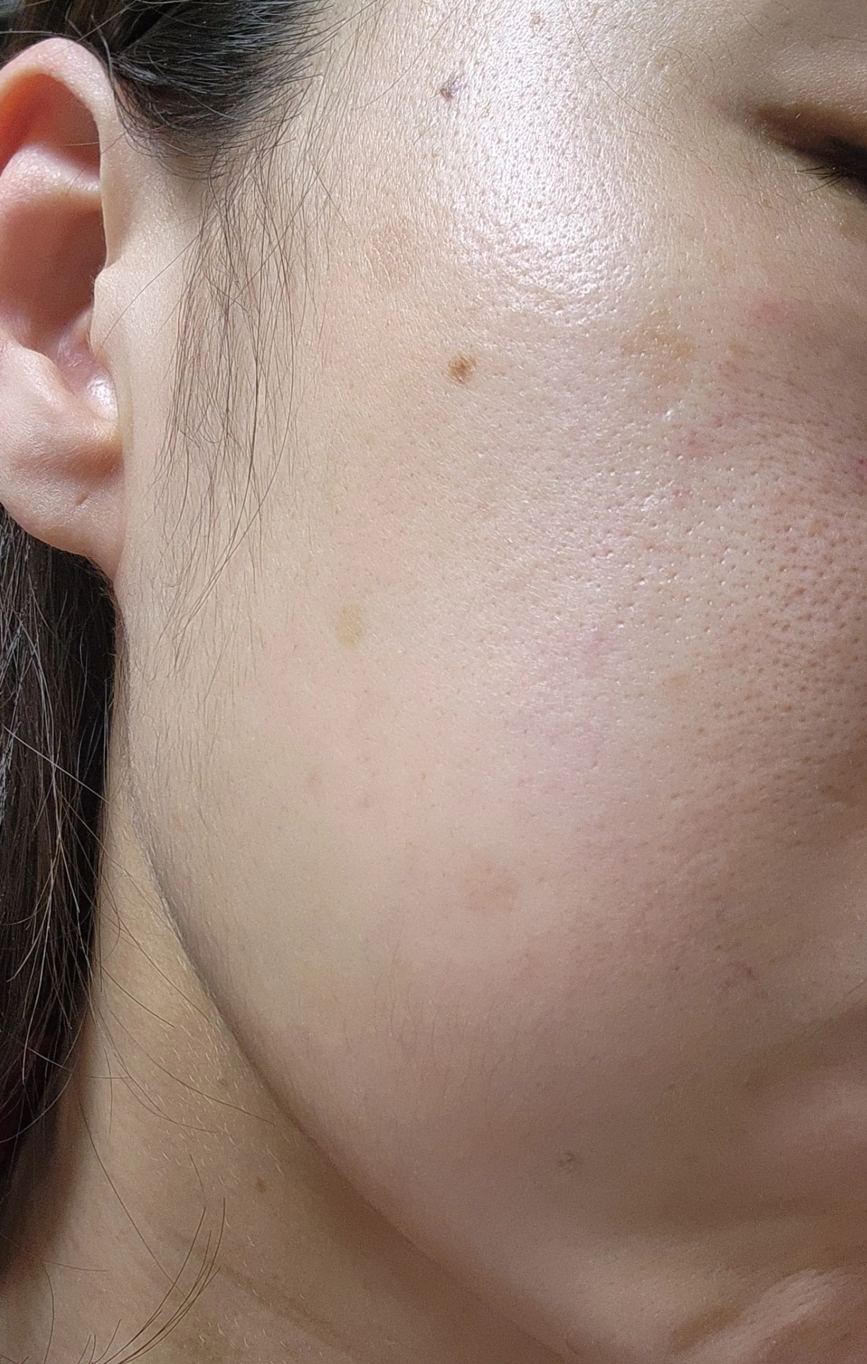 흑자치료전 얼굴 피부 사진 좌