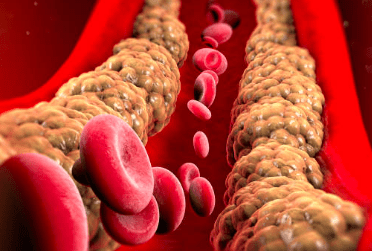 중성지방 낮추는 방법, 중성지방 정상수치