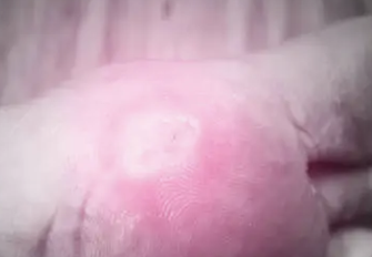 간경화 초기증상 16