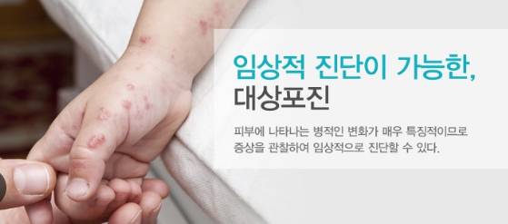 대상포진 초기 증상 후유증