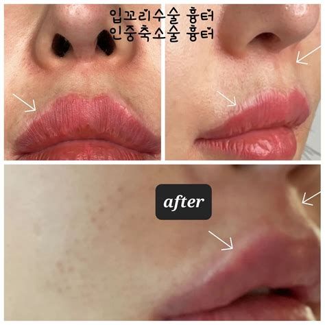 인중 축소 수술