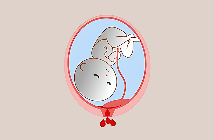 비정상적인-출혈-모습