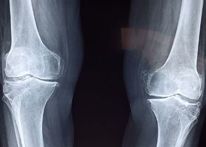 콘드로이친 부작용