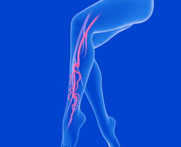 하지 정맥류 증상 수술비용
