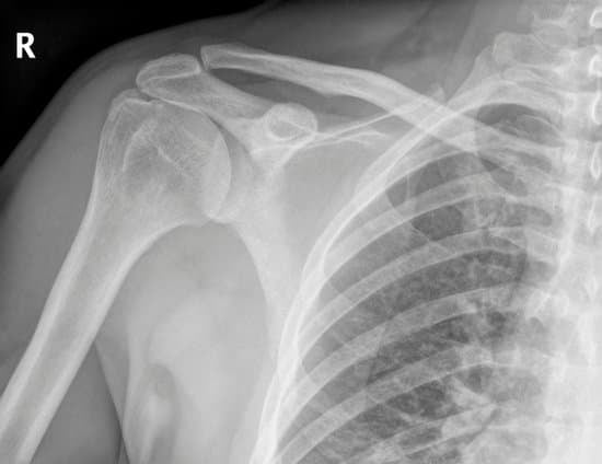 영상 진단: X-레이를 통한 어깨 질환 평가