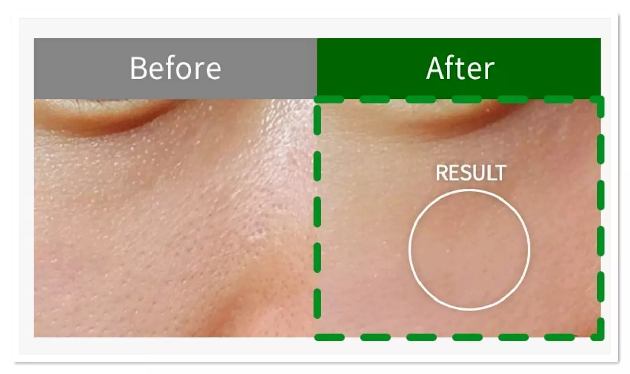 3주간 비쏠르 동안크림을 발랐을 때 쫀쫀한 모공 축소