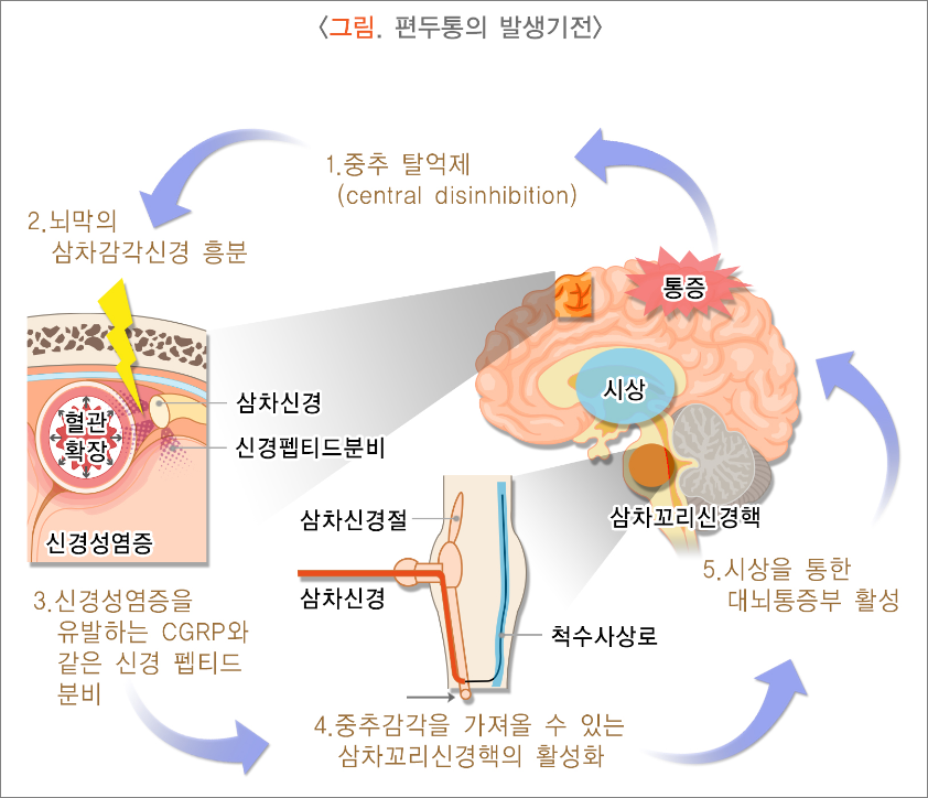 편두통 발생 기전