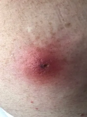 엉덩이 종기가 생기는 이유 왜 생기고 어떻게 관리할까요 완벽 가이드_15