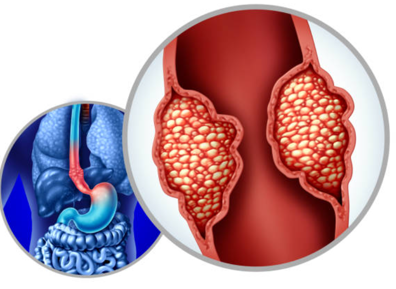 식도암 관련 사진 1
