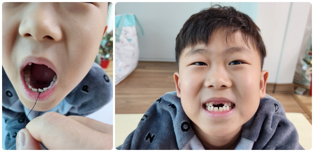 이빨 뺴는 사진