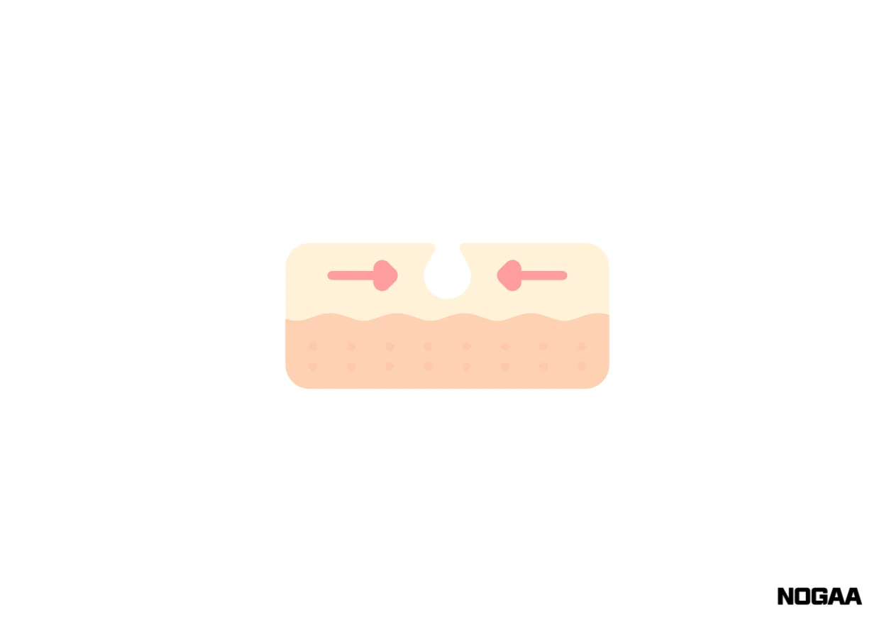 모공각화증 치료 방법