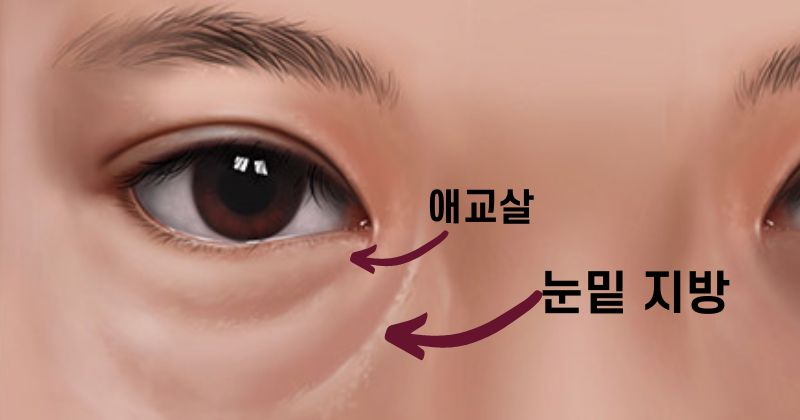눈밑 지방