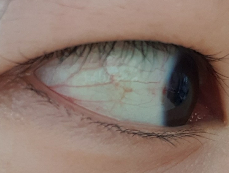 눈 흰자 물집 제거 후