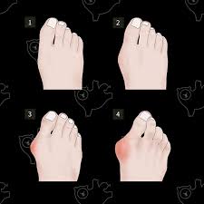 수술 전후의 발 모양 비교, 무지외반증을 가진 발의 모습, 또는 수술 과정을 설명하는 그림