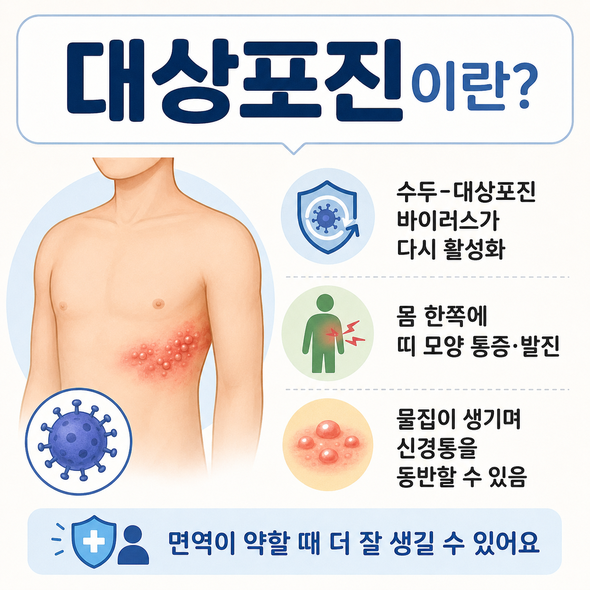 대상포진 초기증상
