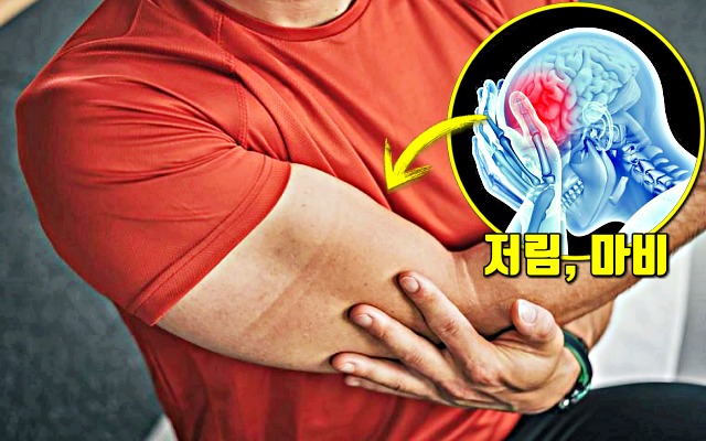 힘이 빠지는 뇌졸중 전조 증상, 뇌경색 초기증상, 뇌졸중 초기증상, 건강 팁줌 매일꿀정보