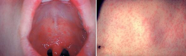 홍역 증상 (홍역과 수두 차이점)