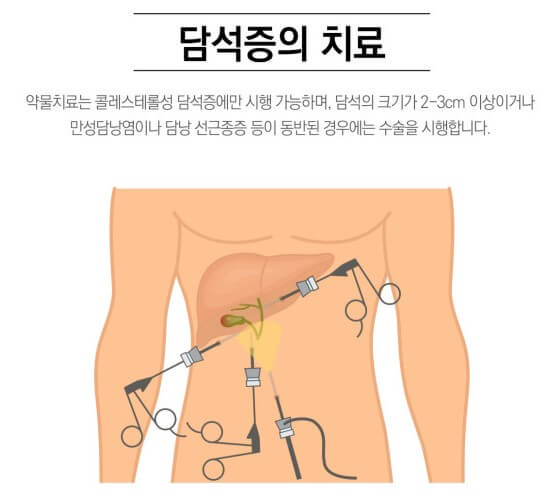담석증 치료