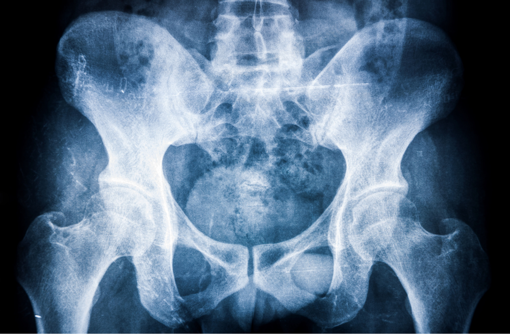 강직성 척추염 치료법