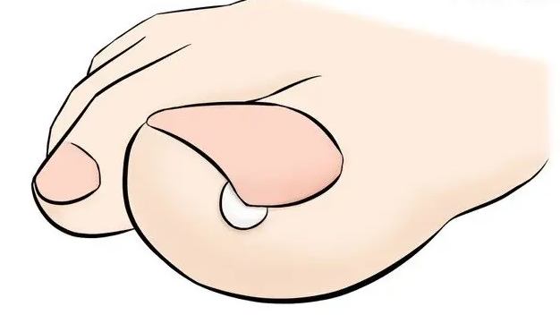 발톱이 파여 있는 부분에 솜을 채우다