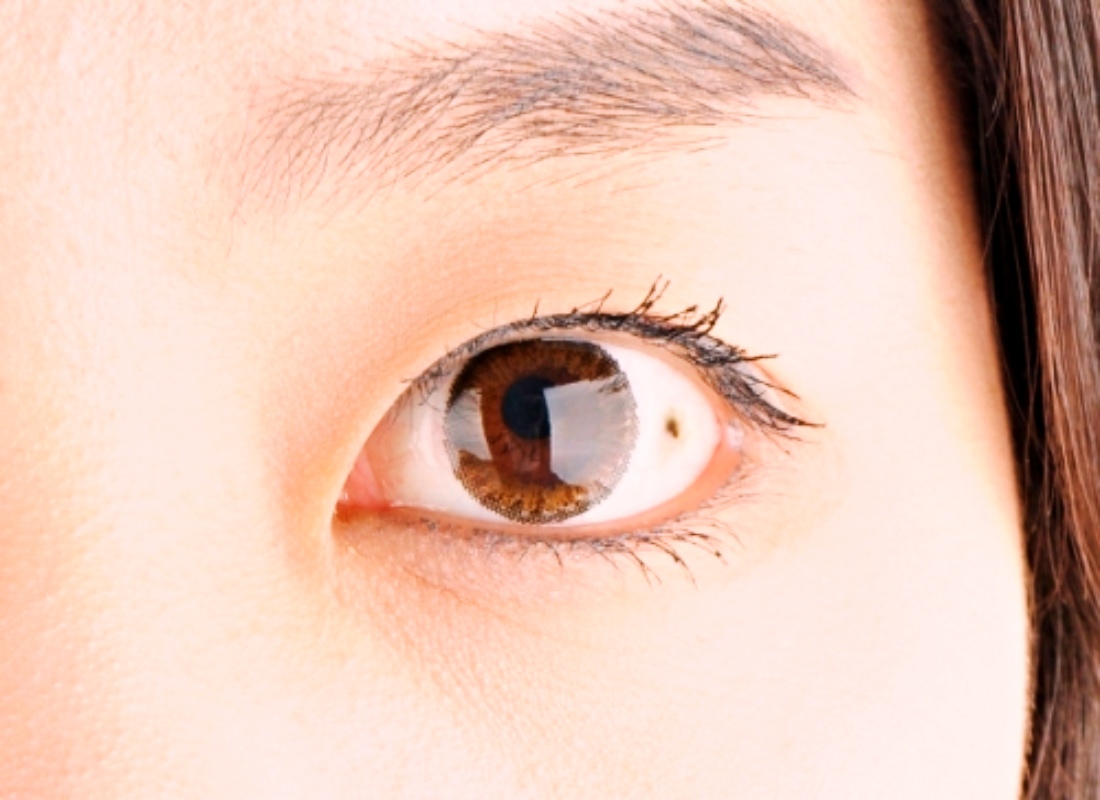 결막 모반 사진