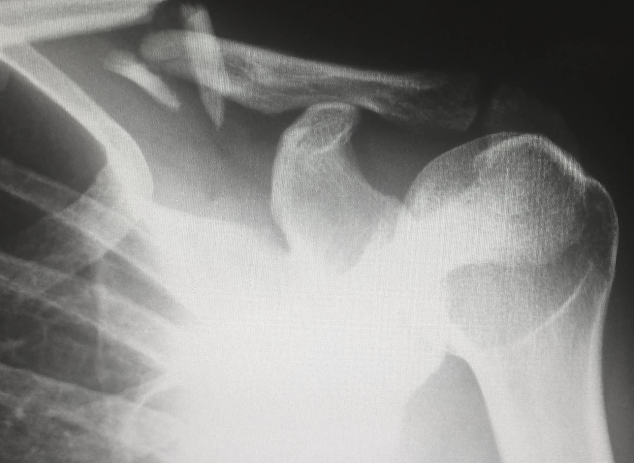 석회화건염-오십견