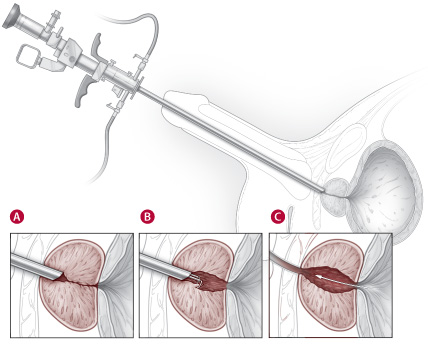 경요도전립선절제술
