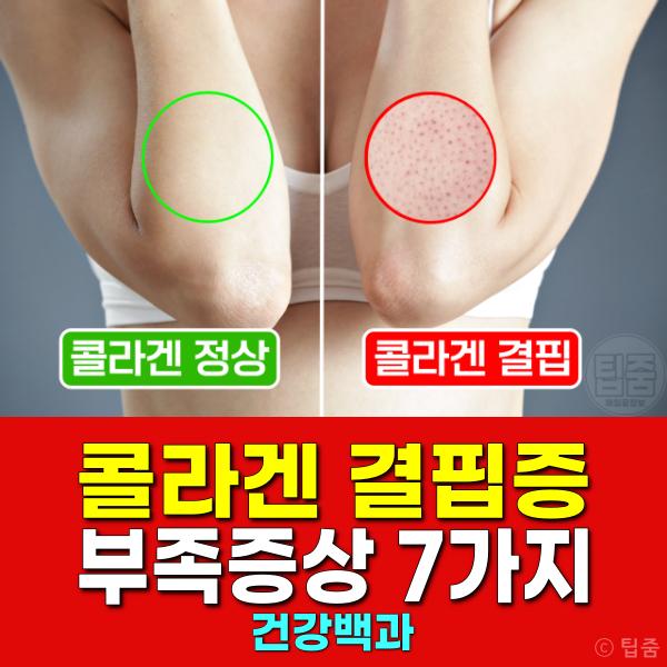 콜라겐 결핍증 부족증상