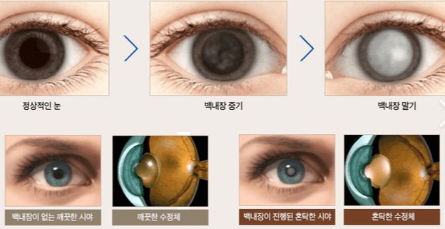 백내장의 진행과정과 수정체의 모습을 보여주는 그림