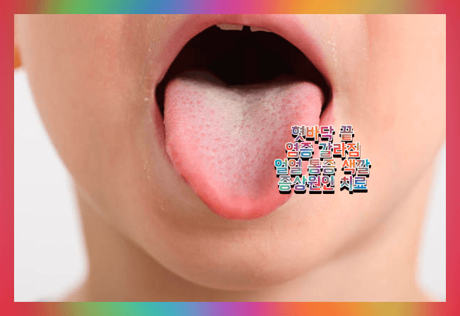 혀 갈라짐 통증 증상