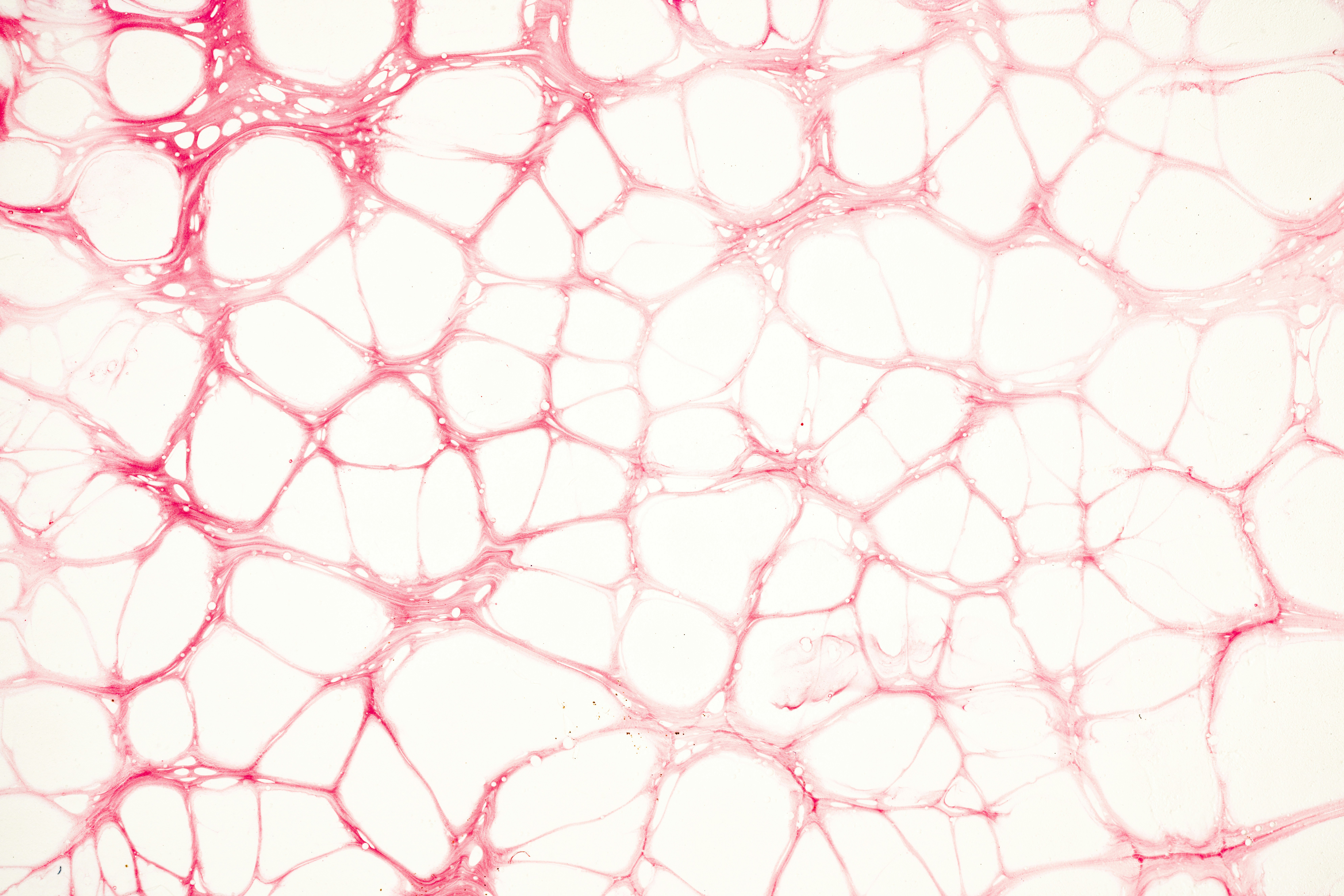 지주막하 출혈 증상 원인 후유증 / 지주막하 출혈 재발 확률 / 수술 비용 및 건강보험 적용 시 수술비용