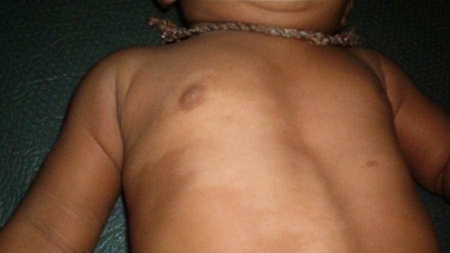 백반증 완벽 가이드