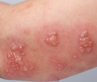 대상포진은 수포(물집)