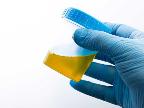 소변 알부민/크레아티닌 비율 (ACR)