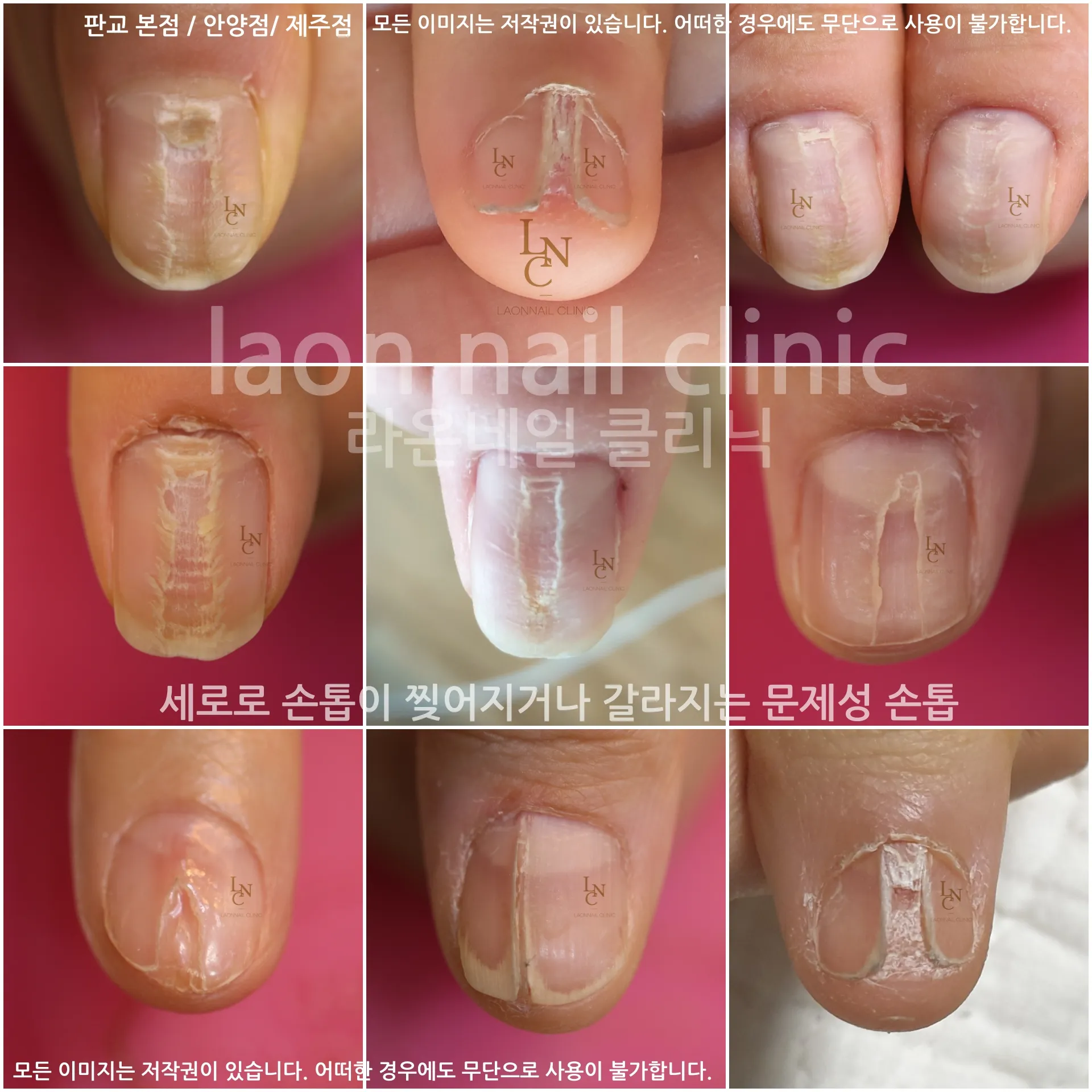 손톱이 갈라지는 이유 원인 증상 대처법_4