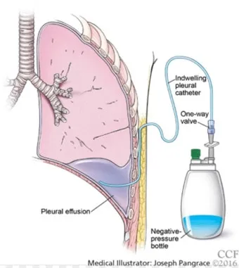 폐에 물이 차는 원인 증상 물참 관리 포인트에 대한 건강정보_7