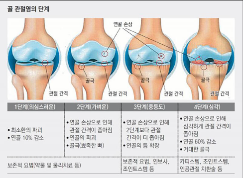 골관절염