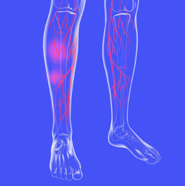 하지정맥류-수술비용