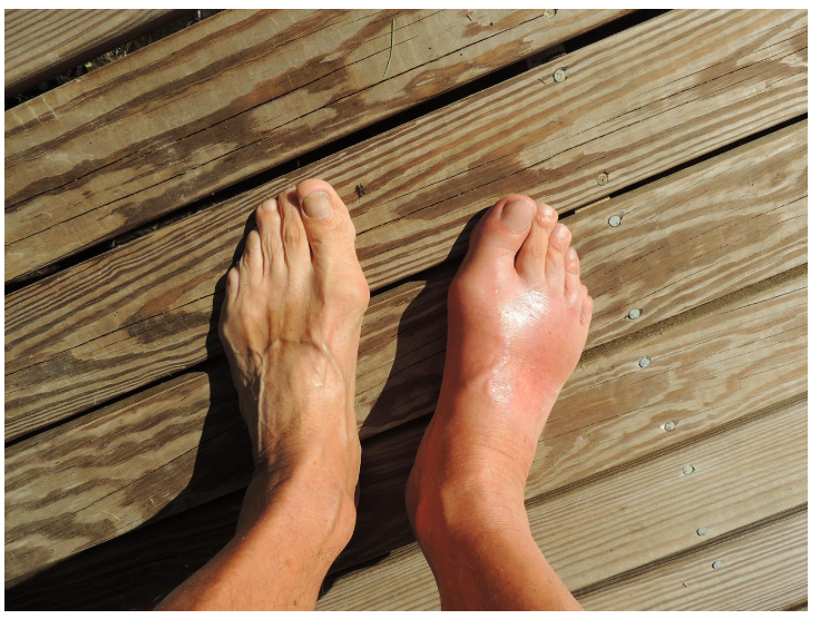 왕의 병, 통풍: 원인부터 치료까지 완벽 가이드