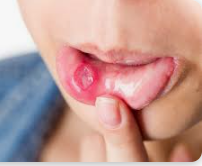 혓바늘이 돋는 이유 알아보기