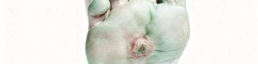 사마귀 제거방법