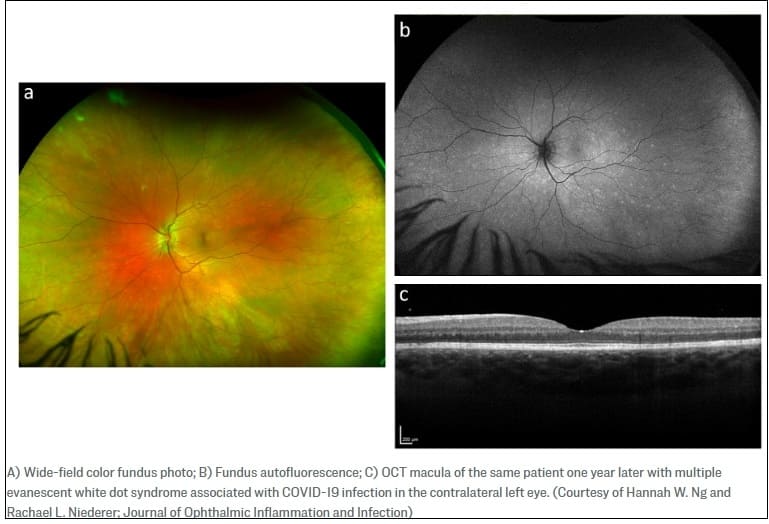'코로나19 백신과 바이러스' 연관 희귀 눈병 사례 최초 발표 First Case of White Dot Syndrome Emerged After COVID-19 Vaccine and Subsequent Infection, Study Shows