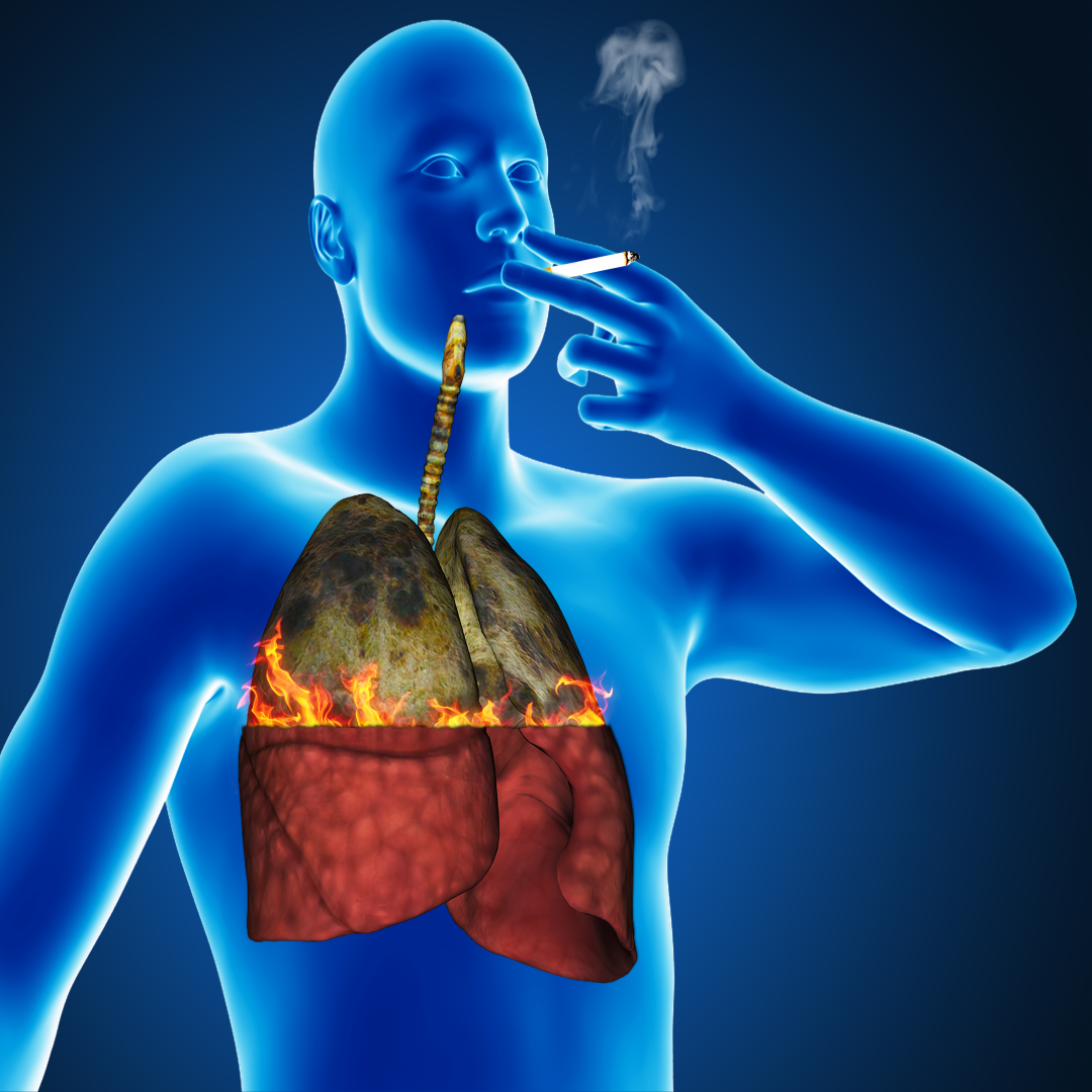 건강검진으로는 못 찾는 폐암 전조 행동 생활습관, 미세먼지, 습도