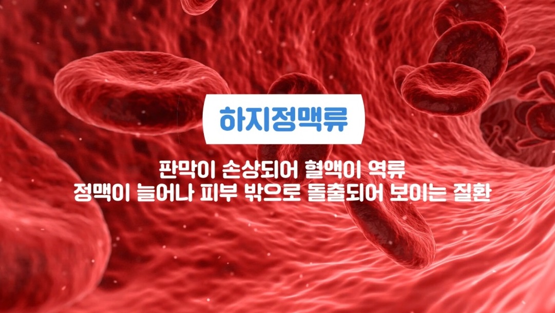 박기혁-교수-하지정맥류-다리-혈관-질환