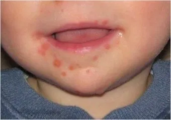 수족구병 증상과 예방 조치 방법 모음_14